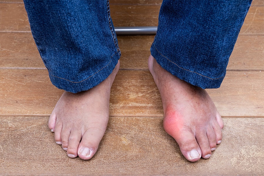 Halluks Valgus